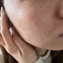 ピコフラクショナルレーザー（毛穴・ニキビ跡） CLINICA BellaForma BEFORE サムネイル用