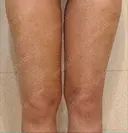 インディバ（脚） WOM SALON【術後ケア取扱いサロン】 BEFORE サムネイル用