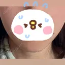 脂肪溶解注射（顔） LIGHT CLINIC 【ライトクリニック】 名古屋院 BEFORE サムネイル用