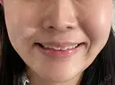ピーリング（ニキビ・毛穴） / ピーリング（ハリ・ツヤ） MKクリニック 日本橋院 BEFORE サムネイル用