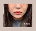 肌ヒアルロン酸注入（たるみ・シワ改善） / ヒアルロン酸注入（唇） TCB東京中央美容外科 中野院 BEFORE サムネイル用