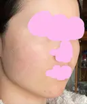 ボトックス（エラ・小顔） TCB東京中央美容外科 上野院 BEFORE サムネイル用