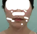 脂肪吸引（顔） / ジョールファット除去 / 脂肪注入（輪郭） WOM CLINIC GINZA （ワム クリニック ギンザ） BEFORE サムネイル用