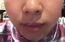 ガミースマイル手術 / 脂肪溶解注射（顔） 湘南美容クリニック 浜松院 BEFORE サムネイル用