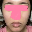 ヒアルロン酸注入（唇） / ボトックス（口角） / ヒアルロン酸注入（頬） KAGA CLINIC BEFORE サムネイル用