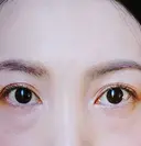 クマ治療 / 下まぶたたるみ取り / スネコス 一宮美容クリニック BEFORE サムネイル用