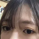 ヒアルロン酸注入（涙袋） Olino美容外科・美容皮膚科 BEFORE サムネイル用