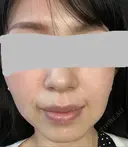 ハイフ（顔） プラチナクリニック BEFORE サムネイル用