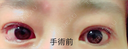二重切開 / 目頭切開 / 眼瞼下垂（切開） / 目尻切開 / 眉下切開 / その他 A CLINIC（エークリニック） 横浜院 BEFORE サムネイル用