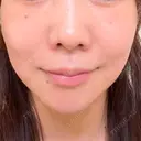 シミ取りレーザー ももスキンケアクリニック BEFORE サムネイル用