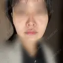 鼻尖形成（切開） / 軟骨移植 / 眉間プロテーゼ / 小鼻縮小（非切開） / 鼻柱下降・鼻唇角形成（猫手術） グローバルビューティークリニック 東京院 BEFORE サムネイル用