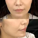 ヒアルロン酸注入（鼻翼基部） 藤・ナチュレ美容クリニック 恵比寿院 BEFORE サムネイル用