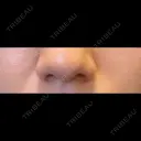 鼻翼基部形成（貴族手術） / ヒアルロン酸注入（涙袋） ルラ美容クリニック 大阪本院 BEFORE サムネイル用