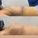 豊胸（シリコン＋脂肪併用） BIANCA表参道 BEFORE サムネイル用
