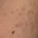 ピコスポット LOUIS CLINIC 二子玉川院【ルイクリニック】 BEFORE サムネイル用