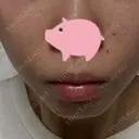 ボトックス（あご） / ヒアルロン酸注入（唇） / ボトックス（眉間） LA CLEF CLINIC（ラクレクリニック） BEFORE サムネイル用