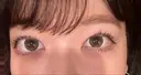 二重埋没 ルラ美容クリニック 名古屋本院 BEFORE サムネイル用