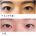 二重埋没 / その他（目元） / 上まぶたの脂肪取り 東京形成美容外科 船橋院 BEFORE サムネイル用