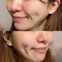 糸リフト / 脂肪吸引注射（顔） 湘南美容クリニック 名古屋栄院 BEFORE サムネイル用