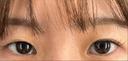 二重切開 水の森美容クリニック 大阪梅田院 BEFORE サムネイル用