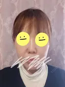 小鼻縮小（切開） / 鼻翼挙上 / 鼻孔縁挙上 / 鼻柱下降・鼻唇角形成（猫手術） Otus Clinic 【オータスクリニック】 BEFORE サムネイル用