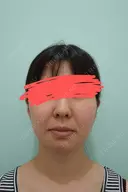 メーラーファット除去 WOM CLINIC GINZA （ワム クリニック ギンザ） BEFORE サムネイル用