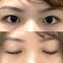 二重埋没 R.O.clinic BEFORE サムネイル用