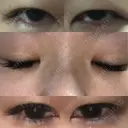 眼瞼下垂（切開） ピュア形成外科医院 BEFORE サムネイル用