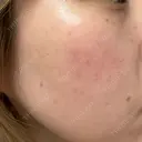 毛穴洗浄（ハイドラフェイシャルなど） / ピコフラクショナルレーザー（毛穴・ニキビ跡） CHARIS BEAUTY CLINIC BEFORE サムネイル用