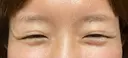 ボトックス（目尻） TCB東京中央美容外科 大宮東口院 BEFORE サムネイル用
