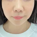 ハイフ（顔） TCB東京中央美容外科 岡山院 BEFORE サムネイル用