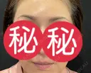 アートメイク（眉） / アートメイク（唇） APスキンクリニック銀座 BEFORE サムネイル用