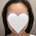 インディバ（顔） WOM SALON【術後ケア取扱いサロン】 BEFORE サムネイル用
