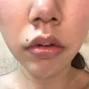 口角挙上 宇都宮竹内クリニック BEFORE サムネイル用