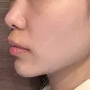 ピコレーザートーニング（美白・肝斑） PICO BEAUTY CLINIC BEFORE サムネイル用