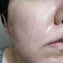 傷跡修正 / ダーマペン 品川美容外科 町田院 BEFORE サムネイル用