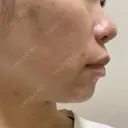 肌ヒアルロン酸注入（たるみ・シワ改善） / ヒアルロン酸注入（あご） シェリークリニック 福岡院 BEFORE サムネイル用