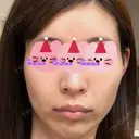 糸リフト / 額を丸く / こめかみ形成 / 脂肪注入（額） eクリニック 金沢本院 BEFORE サムネイル用