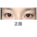 二重切開 水の森美容クリニック 大阪梅田院 BEFORE サムネイル用