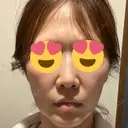 脂肪注入（輪郭） X CLINIC 恵比寿院 BEFORE サムネイル用
