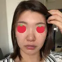 鼻尖形成（切開） / 鼻中隔延長（切開） / 脂肪溶解注射 / ボトックス（肩） / その他（鼻） エートップ美容整形外科 BEFORE サムネイル用
