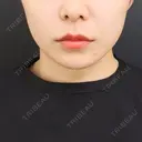 小鼻縮小（切開） / 人中短縮 / 鼻翼挙上 / 口角挙上 Otus Clinic 【オータスクリニック】 BEFORE サムネイル用