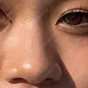 隆鼻術 / 鼻尖形成（切開） / 軟骨移植 / 鼻尖縮小 もとび美容外科クリニック 新宿院 BEFORE サムネイル用