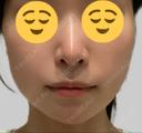 ボトックス（エラ・小顔） KARIS beauty clinic BEFORE サムネイル用