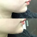 ヒアルロン酸注入（あご） / ボトックス（エラ・小顔） TCB東京中央美容外科 堺院 BEFORE サムネイル用