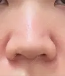 小鼻縮小（切開） くさのたろうクリニック BEFORE サムネイル用