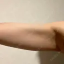 脂肪溶解注射 / その他 HAAB BEAUTY CLINIC 名古屋院 BEFORE サムネイル用