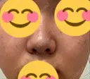毛穴洗浄（ハイドラフェイシャルなど） ミニマムスキンクリニック銀座 BEFORE サムネイル用