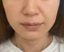糸リフト / ヒアルロン酸注入（あご） ブルームクリニック（BLOOM CLINIC） BEFORE サムネイル用