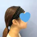 脂肪吸引注射（顔） 湘南美容クリニック 秋葉原院 BEFORE サムネイル用